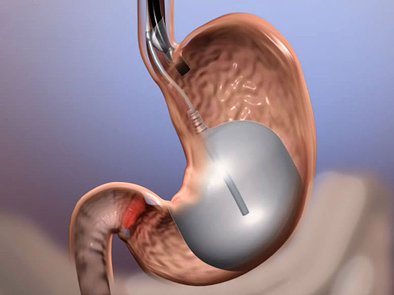 What Is Gastric Balloon Procedure Is It Ideal For You