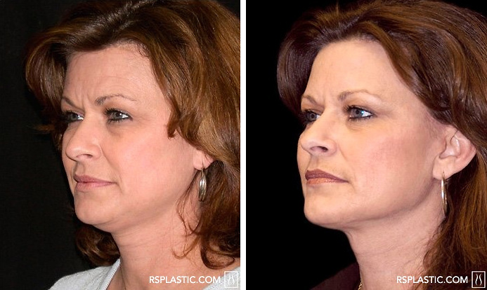 Why Is It Worth It To Go For A Face Lift Procedure?