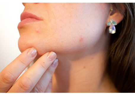 5 Reasons Of Adult Acne You Don’t Know